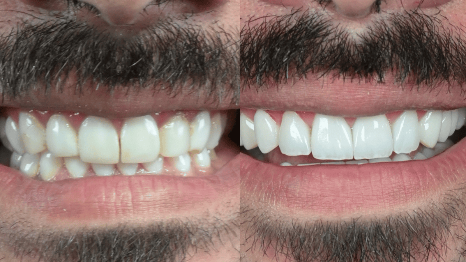Before and after dental veneers treatment showing improved smile aesthetics in Tijuana