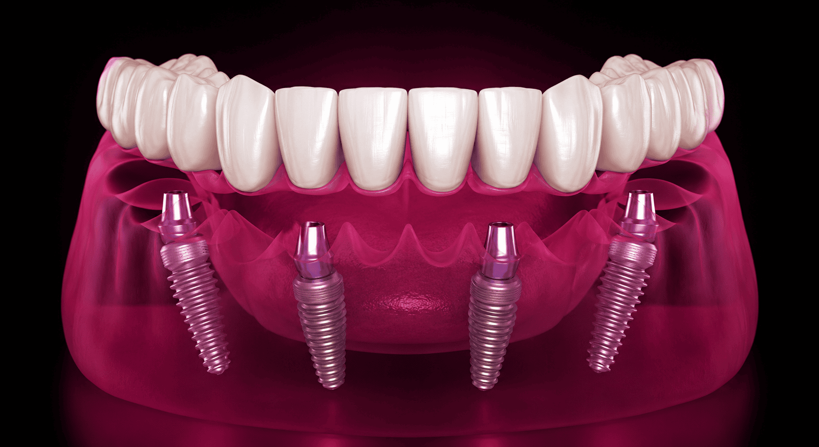 Advanced All-on-4 dental implants in Tijuana at Bites Creadores de Sonrisas.