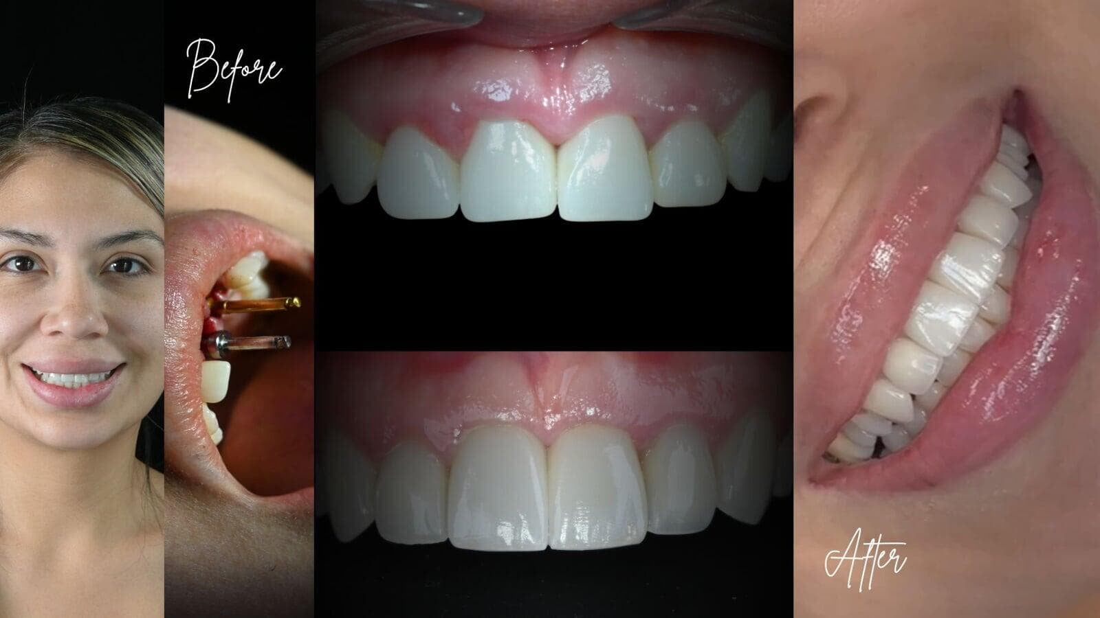 Female patient portrait at a cosmetic dental clinic in Tijuana Mexico after smile design